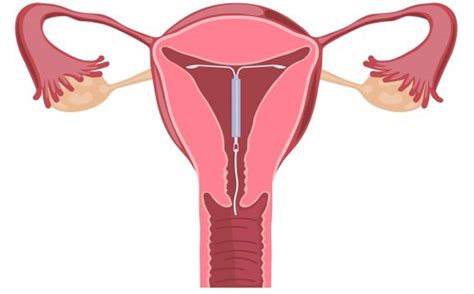 Another great thing about using the copper iud as emergency contraception: What is an IUD? | Birth Control & Contraception | Complete ...