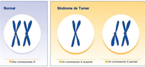 Qué es el síndrome de Turner Federación Mexicana de Diabetes A C
