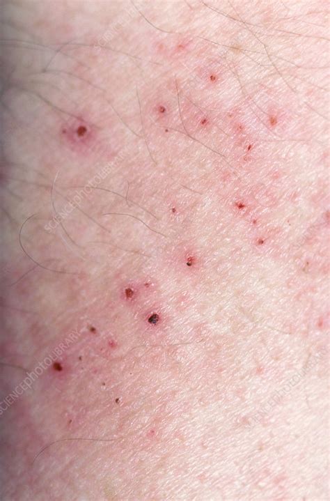 Scabies Stock Image C0144367 Science Photo Library