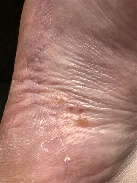 Small Red Spots Appear On My Feet Every Month Or Two Sometimes They