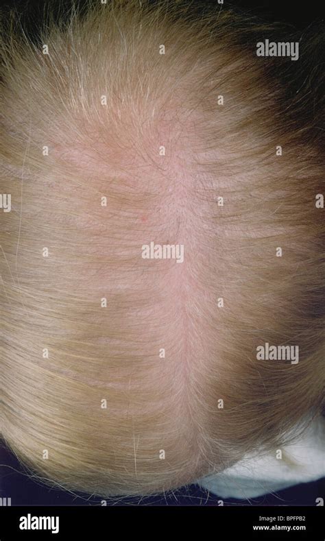Scalp Showing Hair Loss Stock Photo Alamy