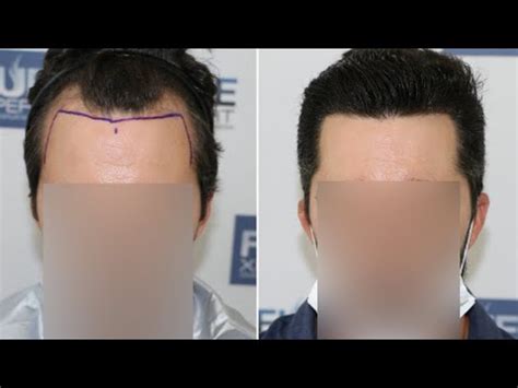Medical tourism for hair transplant. FUE Hair Transplant (1727 Grafts NW III A) By Dr Juan Couto - FUEXPERT CLINIC, Madrid, Spain ...
