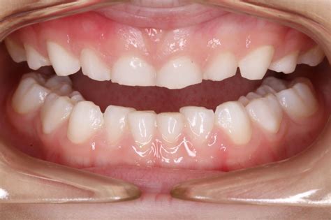 Reviewed by evan frisbee, dmd on january 24, 2020. Sleep bruxism, or teeth grinding is a relatively common ...