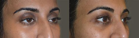 Eyelid And Facial Fat Transfer Before And After Gallery Taban Md