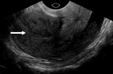 Imaging Unusual Pregnancy Implantations Rare Ectopic Pregnancies And More AJR