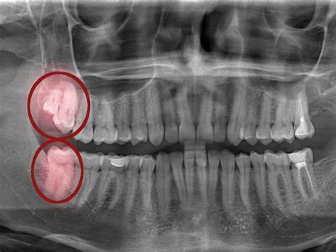 Impacted Wisdom Tooth