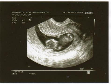 Baby At 33 Week Ultrasound