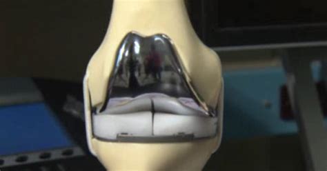 3d Printing Technology Being Used For Customized Knee Transplants Cbs