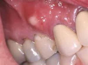 They appear little white or yellow bumps on gums and roof of mouth. Hard, White, Painful Lumps on Lower and Upper Gums Near Mouth.