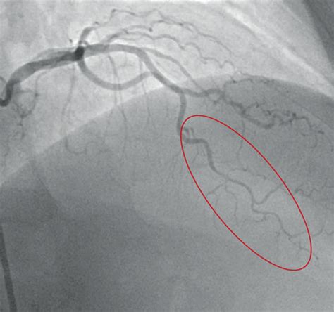 Frame A Initial Angiogram Showing Type 2 Scad With A Long Segment Of
