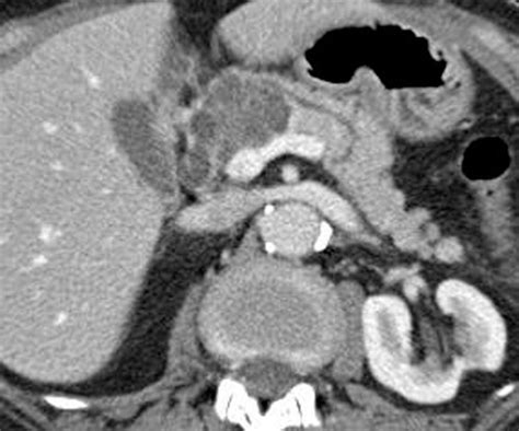 Cystic Lesions Of The Pancreas Radiologic Endosonographic Correlation
