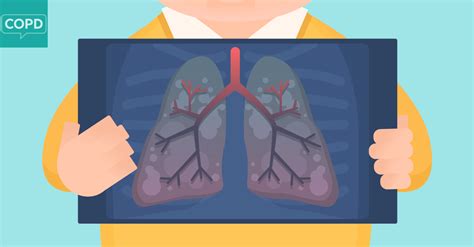 Diagnosing Copd What Are The Symptoms Of Emphysema