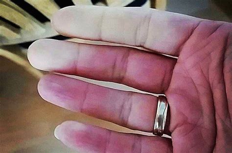 15 Photos That Show What It Looks Like To Live With Raynaud S Syndrome Artofit