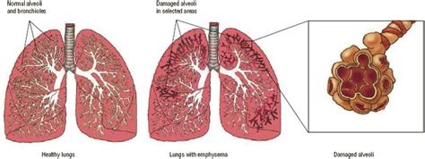 Emphysema Barrys Story What Is Emphysema How Common Is Emphysema
