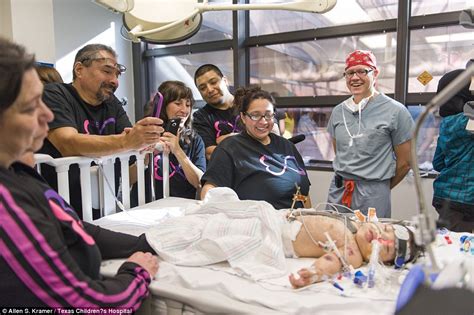 Cojoined Texas Twins Survive World First Operation To Separate Them