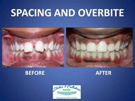 Braces Before And After Spacing And Overbite Invisalign Braces