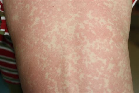 Measles Alert Issued For Brisbane House Call Doctor