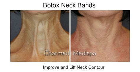 Botox® Dysport® Daxxify Charmed Medispa