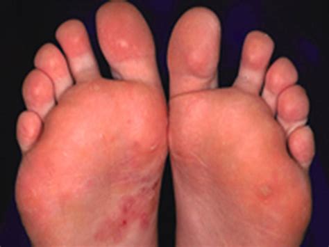Tinea Pedis Fungal Infection Athletes Foot Stock Photo My Xxx Hot Girl