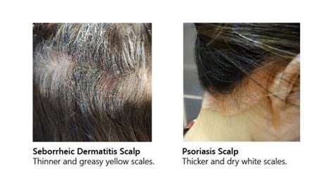 Whats The Difference Between Psoriasis And Seborrheic Dermatitis Scalp