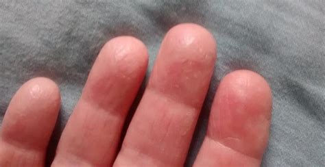 Chapped Cracked Painful Fingers Homeopathy Inspirin