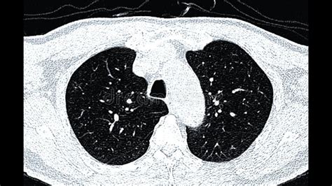 Ct Scan Of Chest Or Lung Axial View For Screening Lung Nodules Stock