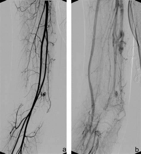 Angiography Demonstrated The Intact Upper Limb Arterial Open I
