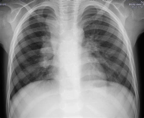Tuberculous Lymphadenopathy Radiology Case
