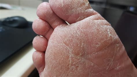 Tinea Pedis Why Constant Treatment Is Important