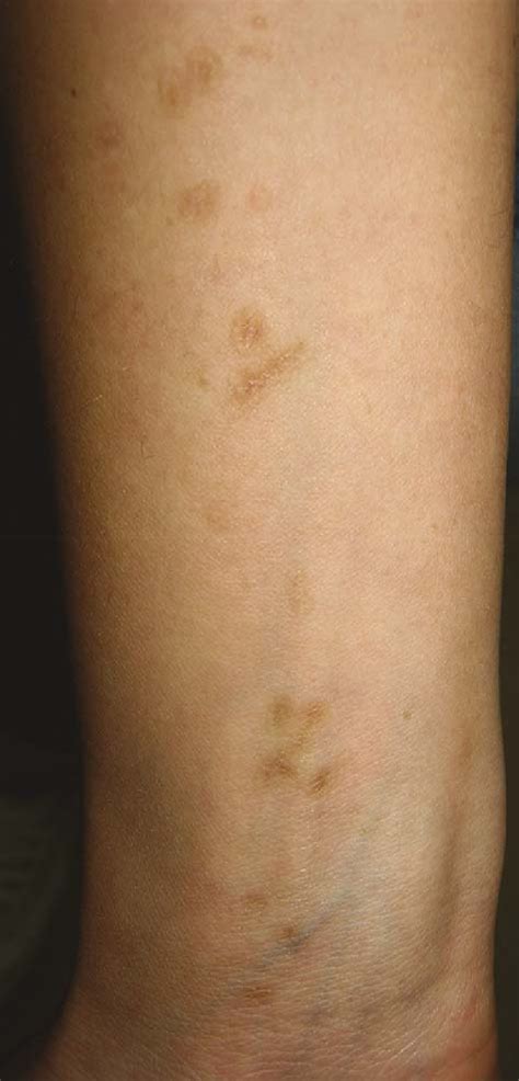 Linear Porokeratosis Changes On The Forearm Detailclose Up