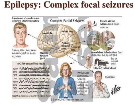 Epilepsy Medplexus