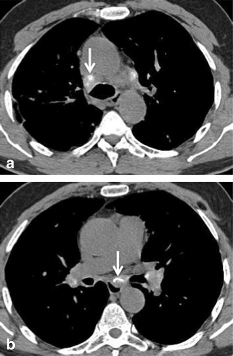 A B Typical Mediastinal Lymph Nodes Calcification In Sarcoidosis A B