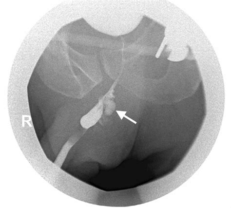 Type V Urethral Injury Retrograde Urethrographic Image Shows Partial