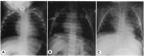 Chest Radiographs Demonstrating Postoperative Progression Of