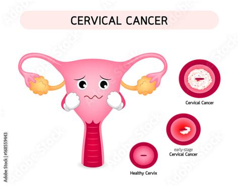 Cervical Cancer Diagram With Sadness Uterus Cartoon Character