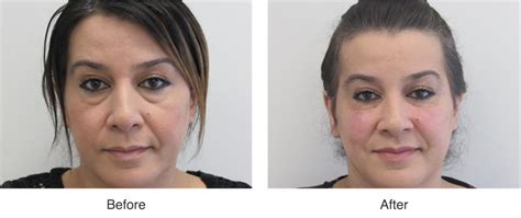 Ottawa Plastic Surgery In Ontario Under Eye Bags Dragging You Down