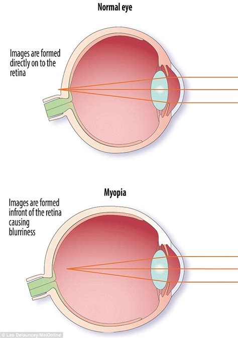 Hyperopia is commonly called farsightedness Half the world's population will be short-sighted in 30 ...
