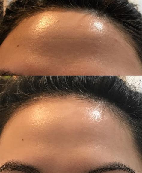 4 Beforeandafter Forehead Lines From Dehydration Skincareaddiction
