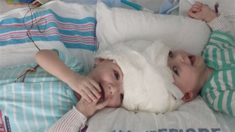 Conjoined Twins Finally Separated During Rare Surgery Video