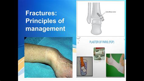 Principles Of Fracture Management Youtube