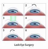 Femtosecond Lasik Eye Surgery
