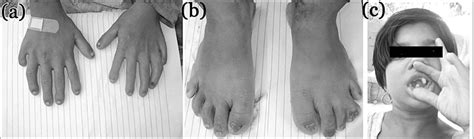 Clinical Presentation Of Individual Iv 4 A Broad Short Hands With