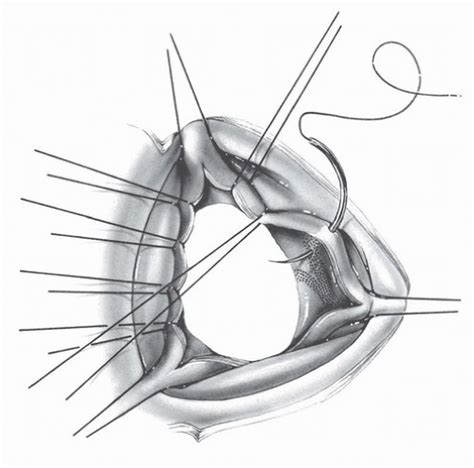 Surgery Of The Aortic Valve Thoracic Key