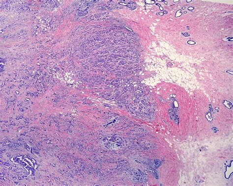 Invasive Carcinoma Of The Breast Light Micrograph Stock Image C046