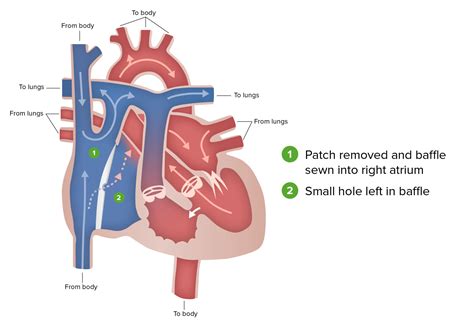 Hypoplastic Left Heart Syndrome Hlhs Concise Medical Knowledge