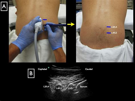 Lumbar Puncture — Highland Em Ultrasound Fueled Pain Management