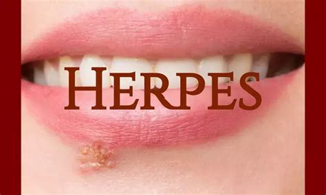 Vaccine Shows Promise Against Herpes Virus