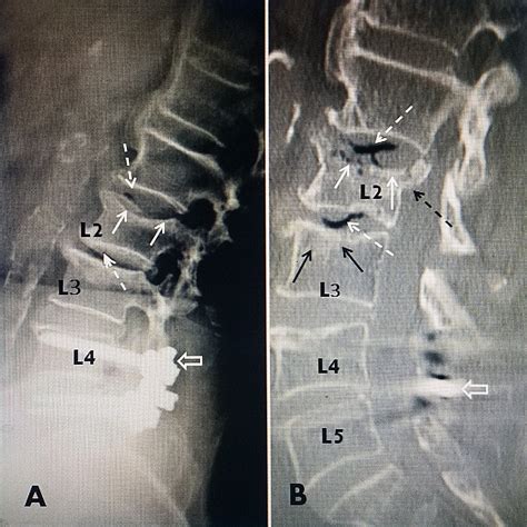 Compression Fracture X Ray