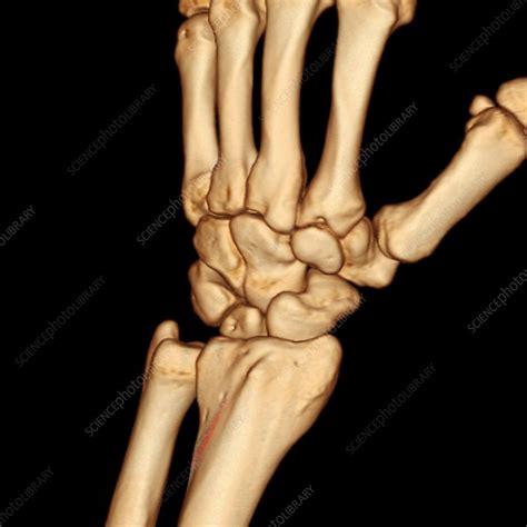 Healthy Wrist Bones 3d Ct Scan Stock Image C0096791 Science