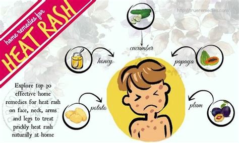 31 Home Remedies For Heat Rash On Face Neck Arms And Legs Heat Rash